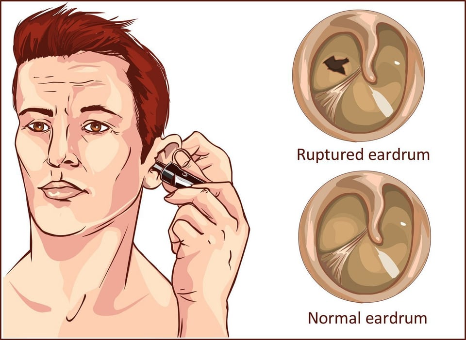 Tympanic Membrane Perforation Symptoms, Causes, and Treatment Options